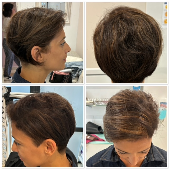 alopecie perte de cheveux solution calvitie solution normandie paris