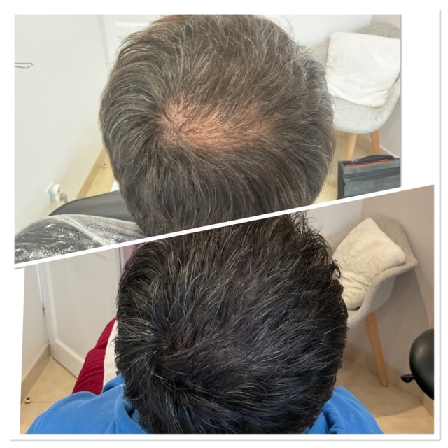 maquillage permanent maquillage permanent tricopigmentation du cuir chevelu perte de cheveux vertex solution douvres la delivrande pres de caen en normandie